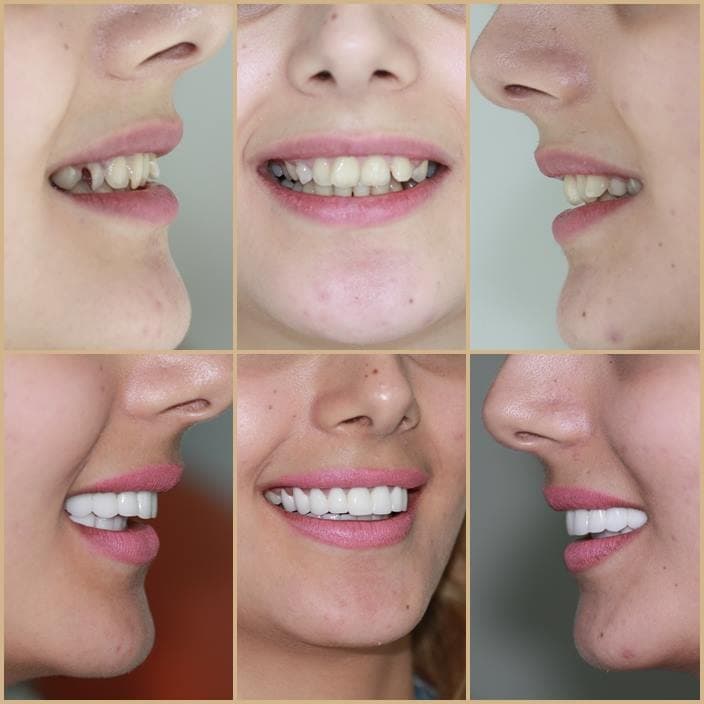 Smile makeover at PresiDental Esthetics